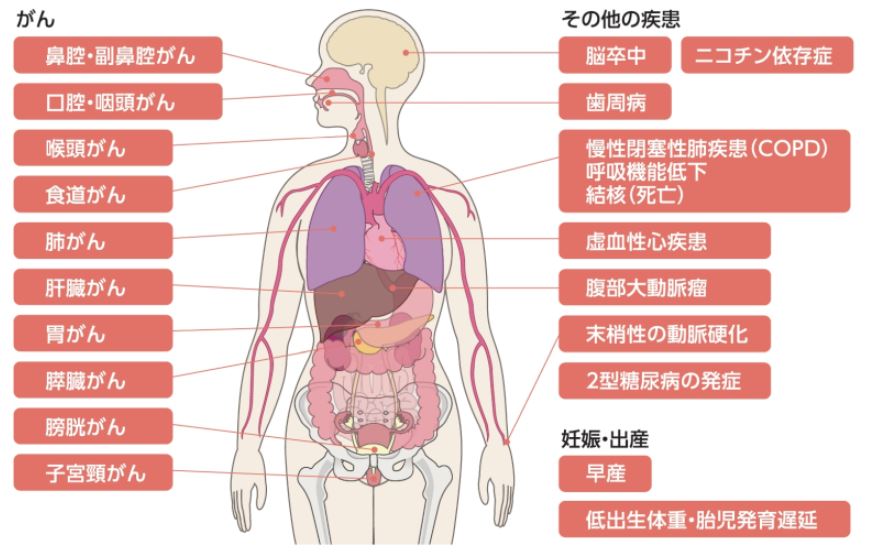 喫煙はがん、脳卒中、歯周病、ＣＯＰＤ、結核、虚血性心疾患、動脈硬化、糖尿病などの原因になります。