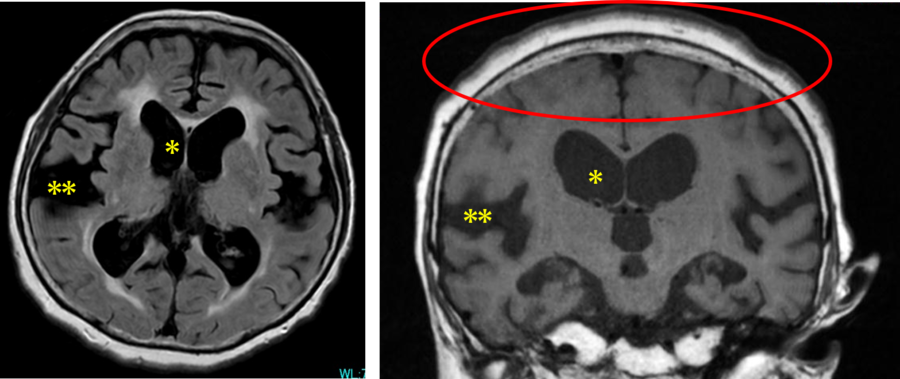 正常圧水頭症の画像
