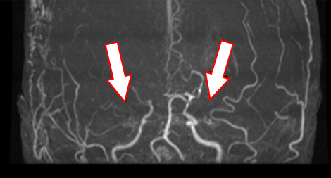 頭蓋内血管の閉塞がみられます。