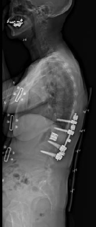 圧潰の強い椎体骨折の術後レントゲン画像２