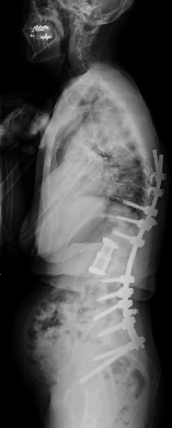 数カ所に及ぶ椎体骨折の術後レントゲン画像