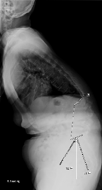 数カ所に及ぶ椎体骨折の術前レントゲン画像