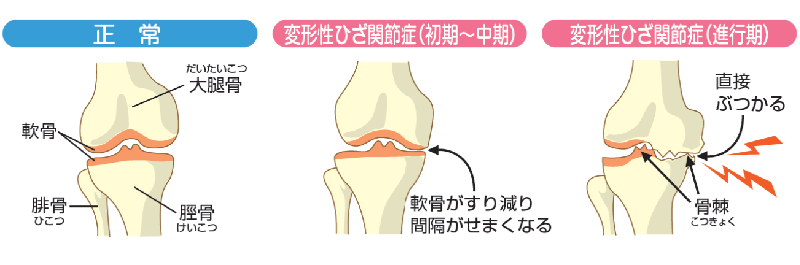 正常なひざと変形性ひざ関節症の違いのイラスト