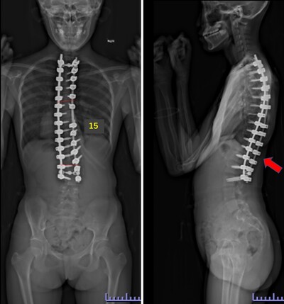 脊柱側弯症の術後レントゲン画像