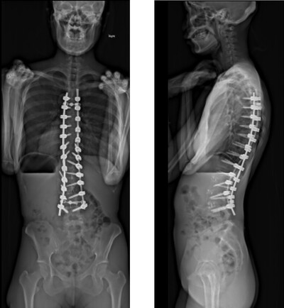 壮年期特発性側弯症遺残変形の術後画像
