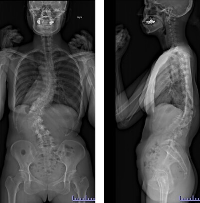壮年期特発性側弯症遺残変形の術前画像