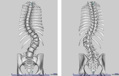 壮年期特発性側弯症遺残変形の術前画像