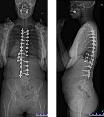 壮年期特発性側弯症遺残変形の術後画像