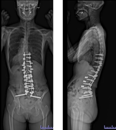 成人脊柱変形の術後画像