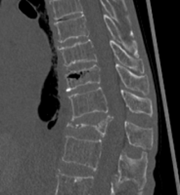 椎体骨折の術前画像