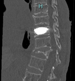 椎体骨折の術後画像