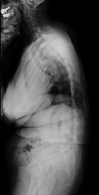 変性後側弯症の術前レントゲン側面画像