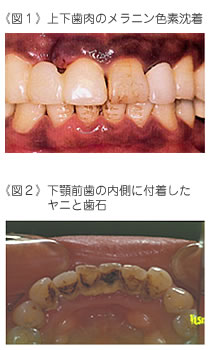 色素沈着と歯に付着したヤニの画像