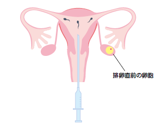 人工授精の図